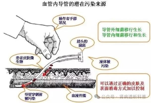 有哪些常見的交叉感染類型及其癥狀，交叉感染是什么？