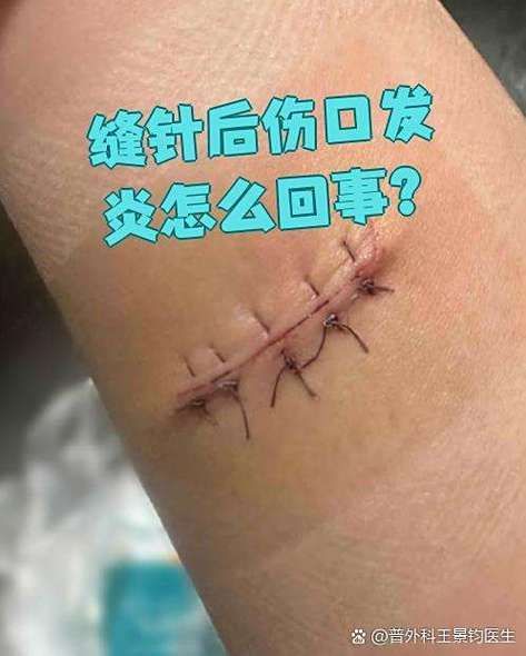 有哪些常見的交叉感染類型及其癥狀，交叉感染是什么？