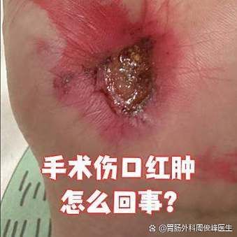 有哪些常見的交叉感染類型及其癥狀，交叉感染是什么？