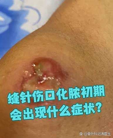 有哪些常見的交叉感染類型及其癥狀，交叉感染是什么？