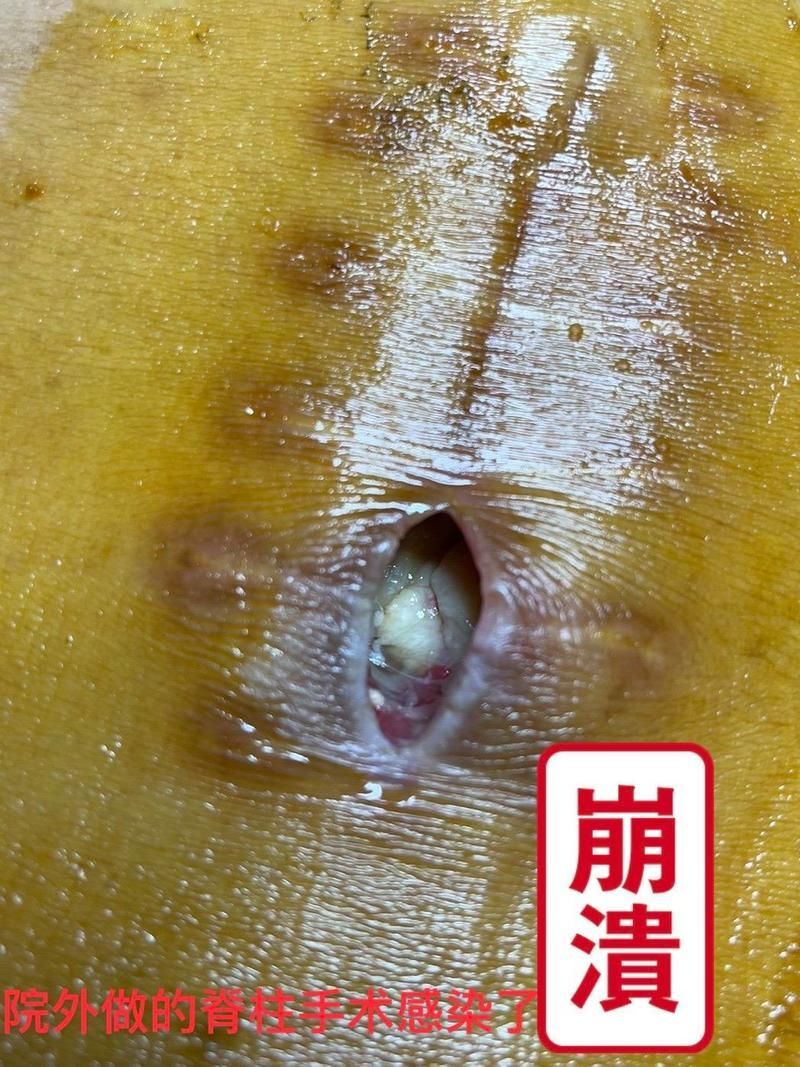 有哪些常見的交叉感染類型及其癥狀，交叉感染是什么？
