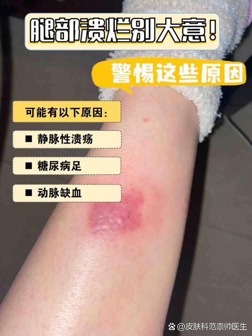 如何區分細菌性和真菌性潰爛，如何區分細菌性與真菌性潰爛 如何區分細菌性和真菌性潰爛，如何區分細菌性與真菌性潰爛 龍魚百科 第4張
