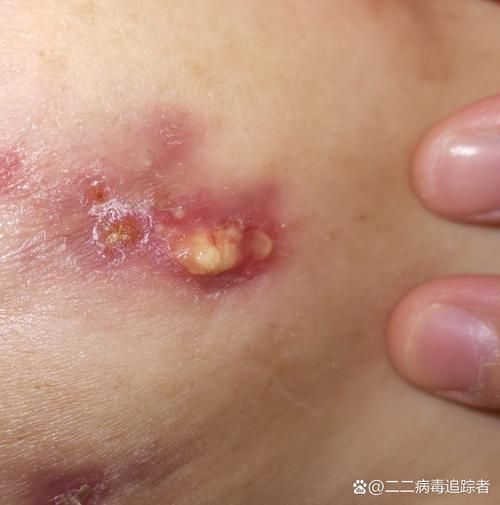 如何區分細菌性和真菌性潰爛，如何區分細菌性與真菌性潰爛 如何區分細菌性和真菌性潰爛，如何區分細菌性與真菌性潰爛 龍魚百科 第5張