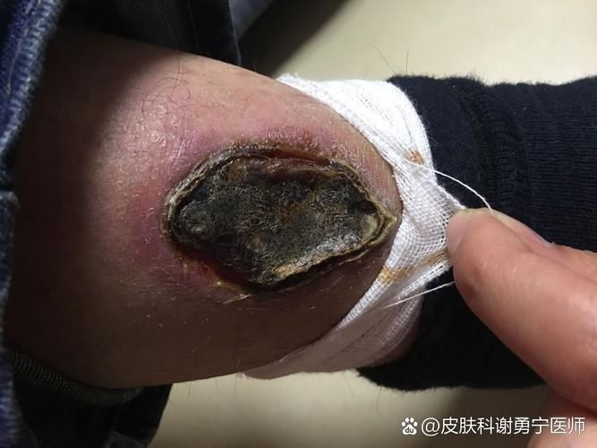 如何區分細菌性和真菌性潰爛，如何區分細菌性與真菌性潰爛 如何區分細菌性和真菌性潰爛，如何區分細菌性與真菌性潰爛 龍魚百科 第3張