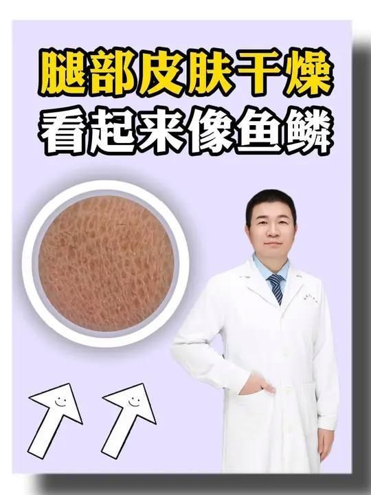 魚鱗病患者如何保持皮膚濕潤(rùn)，魚鱗病患者保持皮膚濕潤(rùn)是關(guān)鍵