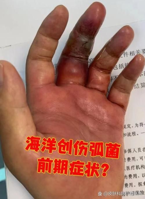 有沒有海洋弧菌感染的早期圖片