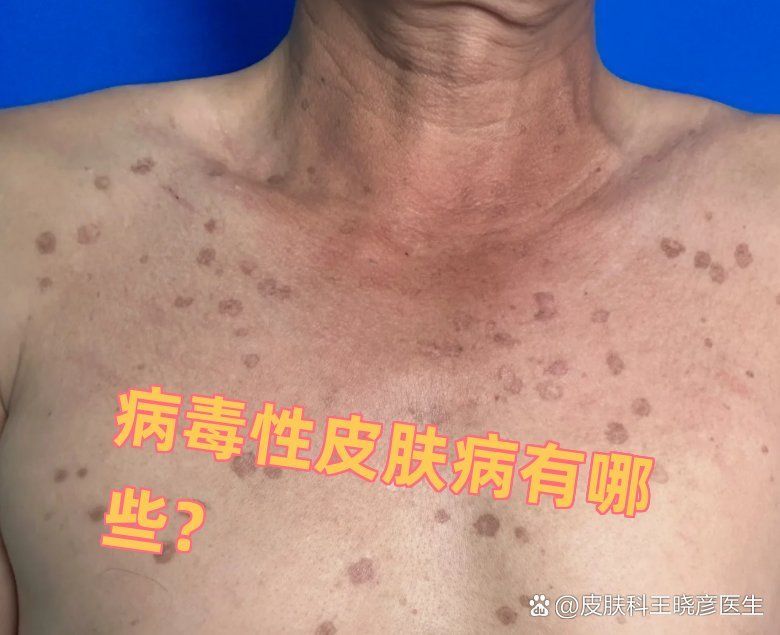 如何區分細菌性和病毒性爛身，如何區分細菌性和病毒性“爛身”