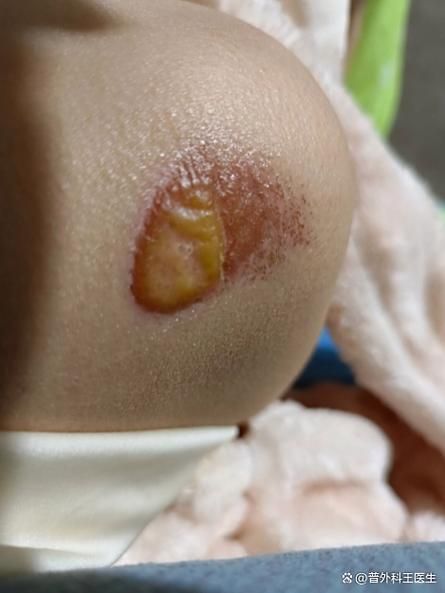 如何預防魚炸傷的發生，如何寫一篇魚炸傷預防指南