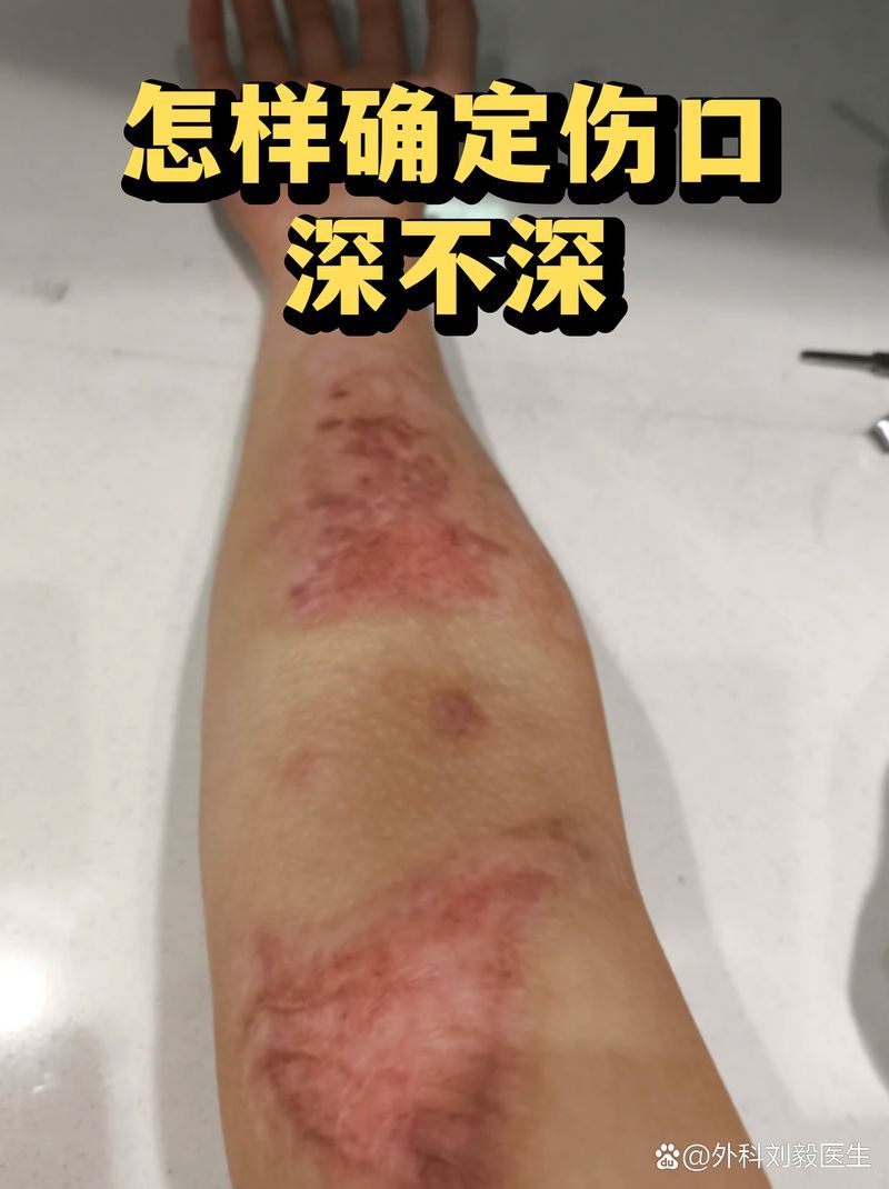 如何判斷傷口是否深，判斷傷口是否深，需要綜合考慮多個因素， 如何判斷傷口是否深，判斷傷口是否深，需要綜合考慮多個因素， 龍魚百科 第2張