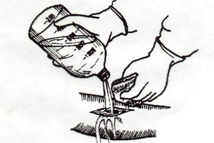 如何預(yù)防傷口感染，中國(guó)手術(shù)預(yù)防傷口感染預(yù)防傷口感染預(yù)防與實(shí)操要點(diǎn)