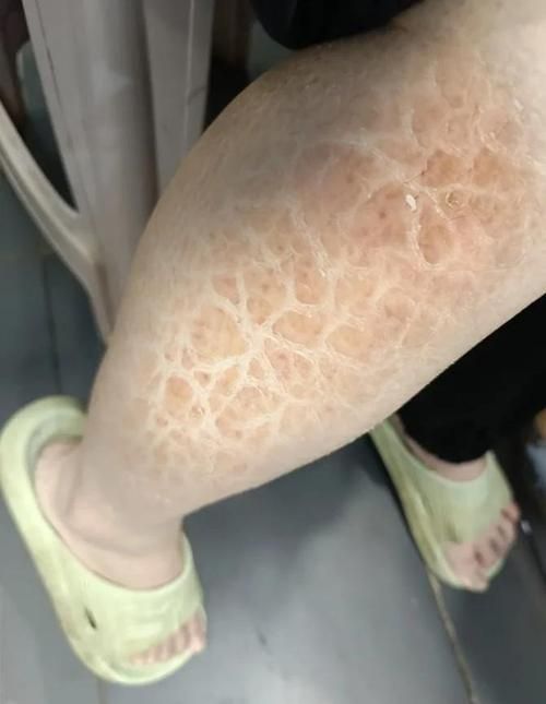 能提供黑身松鱗病的圖片嗎，如何判斷魚是否患有黑身松鱗病