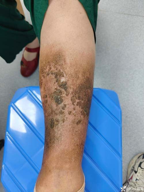 能提供黑身松鱗病的圖片嗎，如何判斷魚是否患有黑身松鱗病