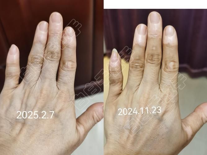 如何判斷魚鱗充血是否嚴重，如何判斷魚鱗充血嚴重