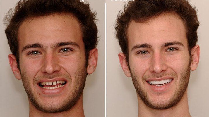 如何矯正龍魚(yú)的地包天，如何矯正龍魚(yú)“地包天” 如何矯正龍魚(yú)的地包天，如何矯正龍魚(yú)“地包天” 龍魚(yú)百科 第4張