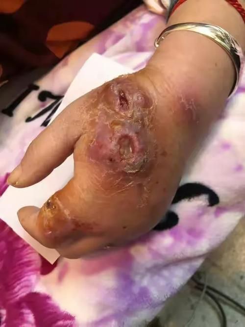 如何判斷自己是否感染了魚缸細(xì)菌，如何判斷自己是否感染了魚缸細(xì)菌思考完成魚缸細(xì)菌思考完成