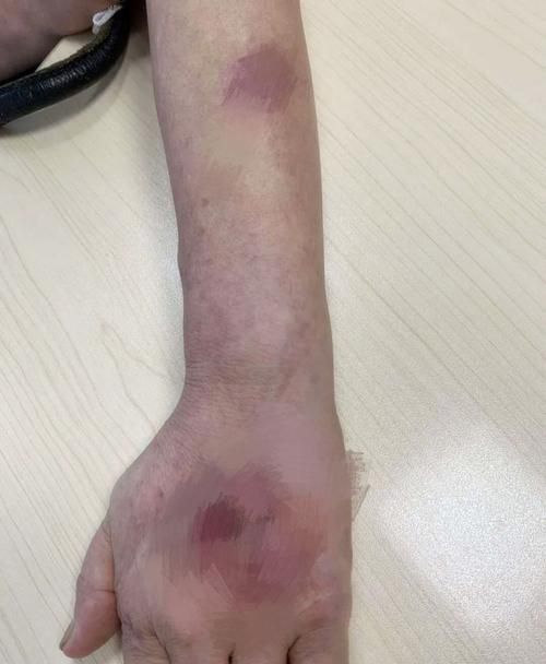 如何判斷自己是否感染了魚缸細(xì)菌，如何判斷自己是否感染了魚缸細(xì)菌思考完成魚缸細(xì)菌思考完成