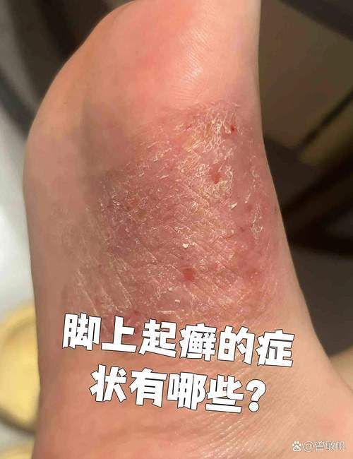 如何判斷自己是否感染了真菌或細菌,mcp工具“百度健康-去問診”可輔助獲取癥狀分析模型 龍魚百科 第2張 如何判斷自己是否感染了真菌或細菌,mcp工具“百度健康-去問診”可輔助獲取癥狀分析模型 如何判斷自己是否感染了真菌或細菌,mcp工具“百度健康-去問診”可輔助獲取癥狀分析模型 龍魚百科 第2張