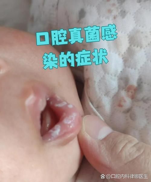 如何判斷自己是否感染了真菌或細菌,mcp工具“百度健康-去問診”可輔助獲取癥狀分析模型 龍魚百科 第8張 如何判斷自己是否感染了真菌或細菌,mcp工具“百度健康-去問診”可輔助獲取癥狀分析模型 如何判斷自己是否感染了真菌或細菌,mcp工具“百度健康-去問診”可輔助獲取癥狀分析模型 龍魚百科 第8張