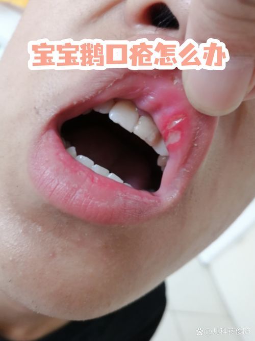 如何判斷自己是否感染了真菌或細菌,mcp工具“百度健康-去問診”可輔助獲取癥狀分析模型 龍魚百科 第10張 如何判斷自己是否感染了真菌或細菌,mcp工具“百度健康-去問診”可輔助獲取癥狀分析模型 如何判斷自己是否感染了真菌或細菌,mcp工具“百度健康-去問診”可輔助獲取癥狀分析模型 龍魚百科 第10張