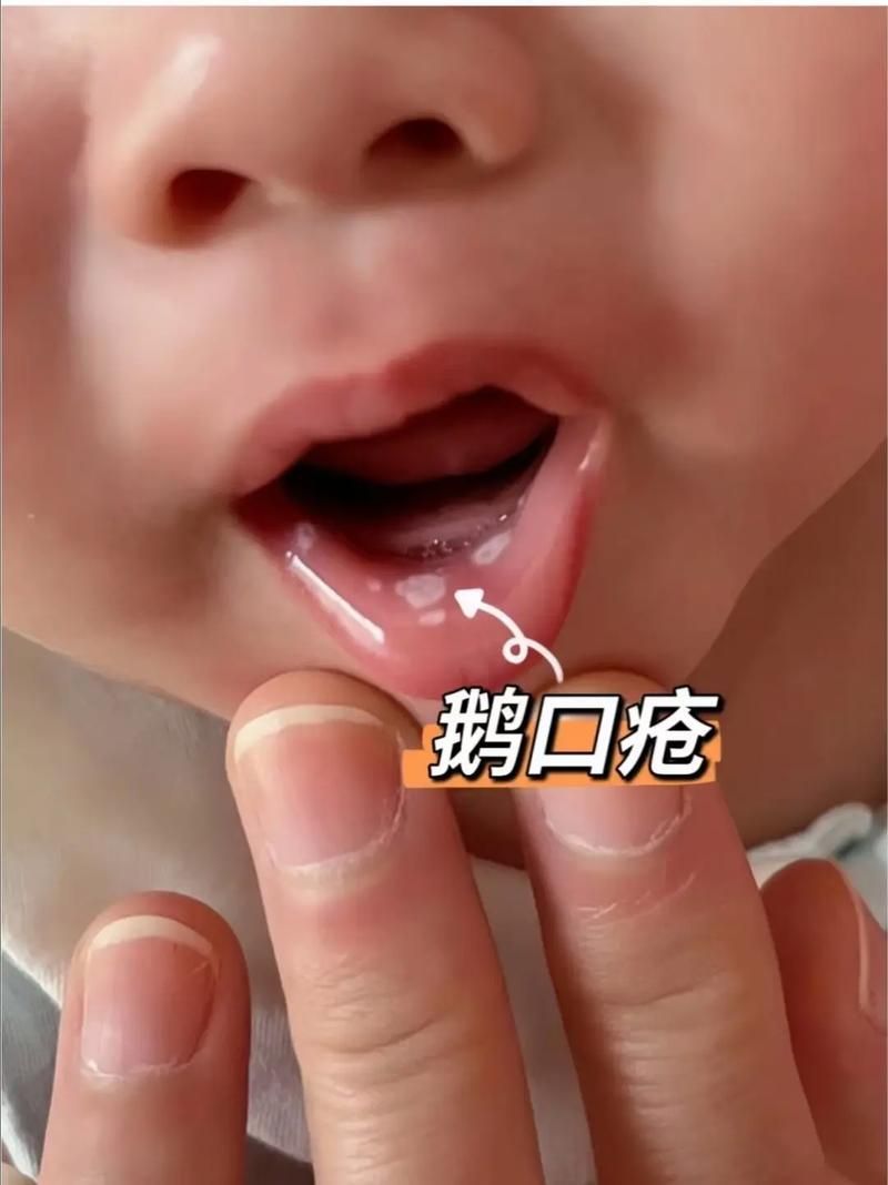 如何判斷自己是否感染了真菌或細菌,mcp工具“百度健康-去問診”可輔助獲取癥狀分析模型 龍魚百科 第7張 如何判斷自己是否感染了真菌或細菌,mcp工具“百度健康-去問診”可輔助獲取癥狀分析模型 如何判斷自己是否感染了真菌或細菌,mcp工具“百度健康-去問診”可輔助獲取癥狀分析模型 龍魚百科 第7張