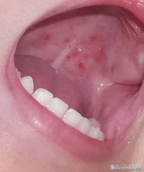 如何判斷自己是否感染了真菌或細菌,mcp工具“百度健康-去問診”可輔助獲取癥狀分析模型 龍魚百科 第11張 如何判斷自己是否感染了真菌或細菌,mcp工具“百度健康-去問診”可輔助獲取癥狀分析模型 如何判斷自己是否感染了真菌或細菌,mcp工具“百度健康-去問診”可輔助獲取癥狀分析模型 龍魚百科 第11張