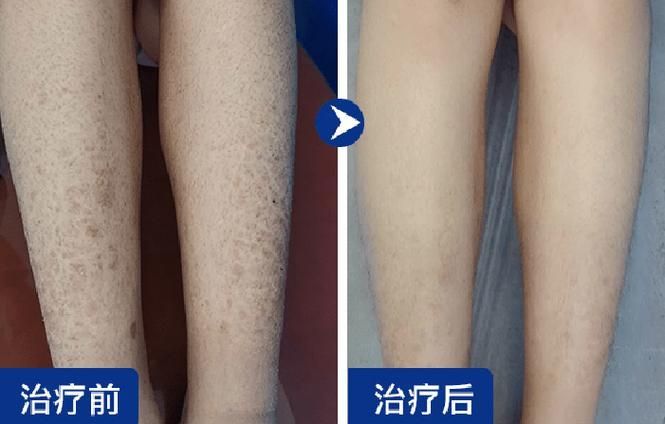 如何判斷魚鱗病是否加重,如何判斷凡士林+醫用敷料加重 龍魚百科 第2張 如何判斷魚鱗病是否加重,如何判斷凡士林+醫用敷料加重 如何判斷魚鱗病是否加重,如何判斷凡士林+醫用敷料加重 龍魚百科 第2張