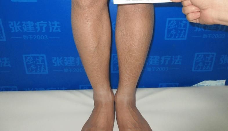如何判斷魚鱗病是否加重,如何判斷凡士林+醫用敷料加重 龍魚百科 第6張 如何判斷魚鱗病是否加重,如何判斷凡士林+醫用敷料加重 如何判斷魚鱗病是否加重,如何判斷凡士林+醫用敷料加重 龍魚百科 第6張