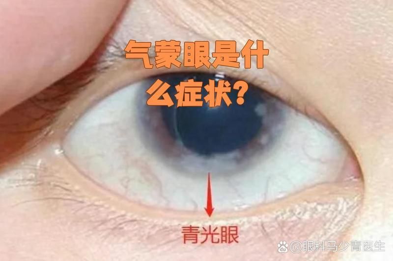 氣蒙眼患者應該如何用眼，西安市人民醫院三甲副主任醫師眼科