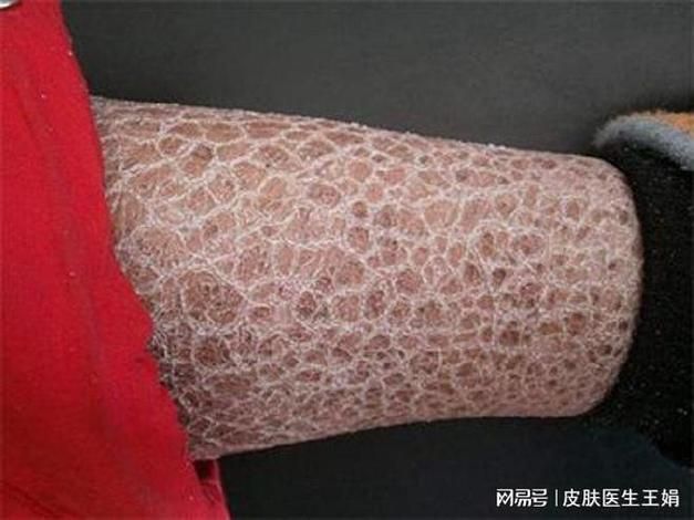 給我一些魚鱗病的圖片示例，如何判斷自己是否患有魚鱗病