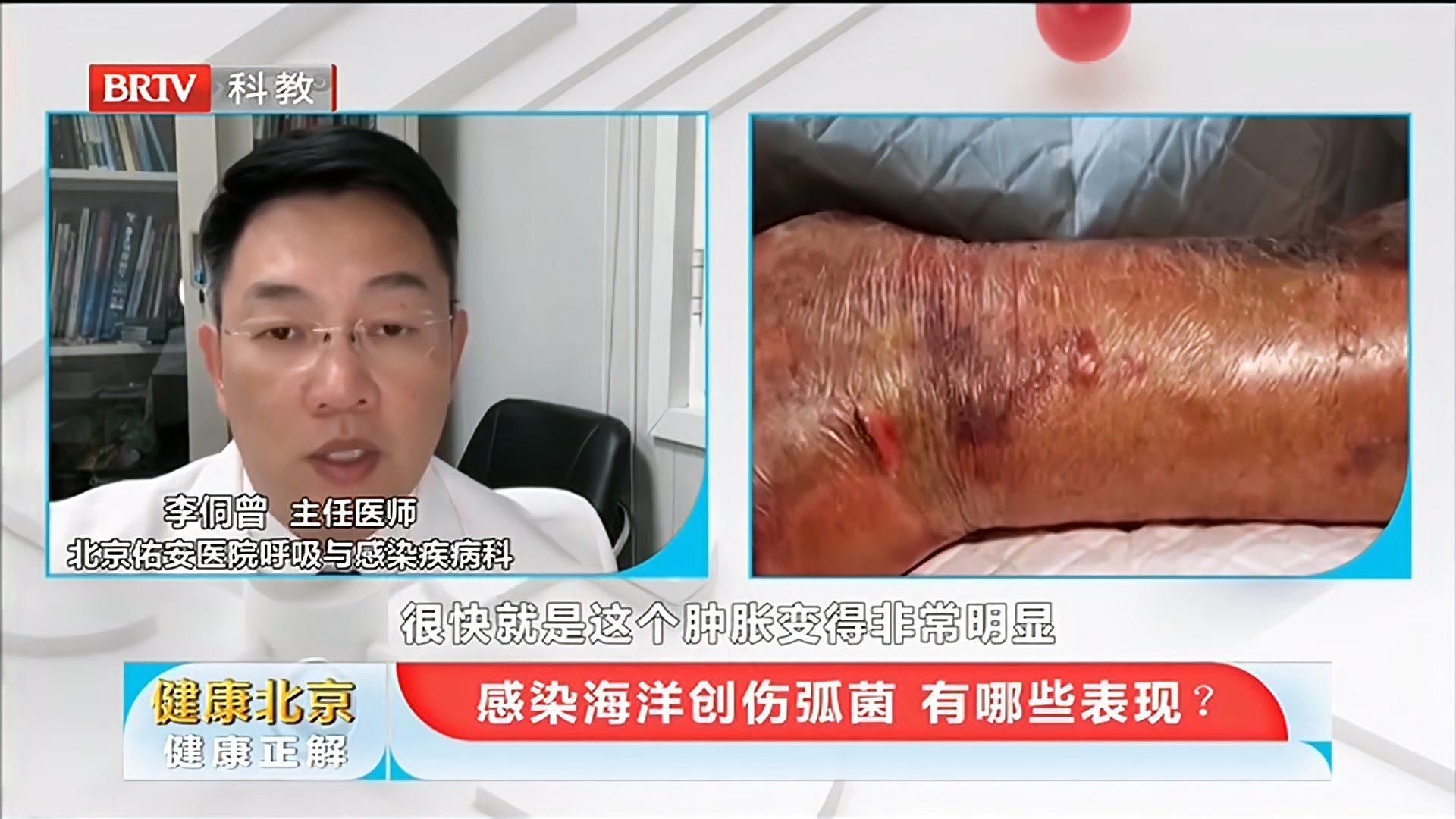 如何判斷自己是否感染了海洋弧菌，如何判斷自己是否感染了海洋弧菌（vibriovulnificus）