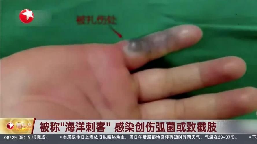如何判斷是否感染了創傷弧菌，如何判斷創傷弧菌感染 如何判斷是否感染了創傷弧菌，如何判斷創傷弧菌感染 龍魚百科 第4張