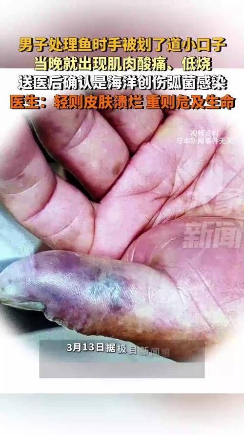 如何判斷是否感染了創傷弧菌，如何判斷創傷弧菌感染 如何判斷是否感染了創傷弧菌，如何判斷創傷弧菌感染 龍魚百科 第3張