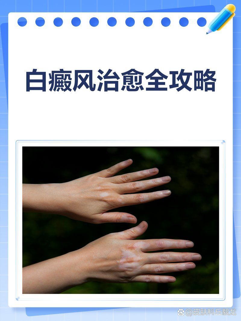 有哪些有效的白點病治療方法，3個方法，教你輕松消除白斑