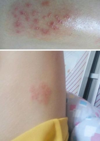 能否提供更多早期癥狀的圖片，早期癥狀的識別與分析