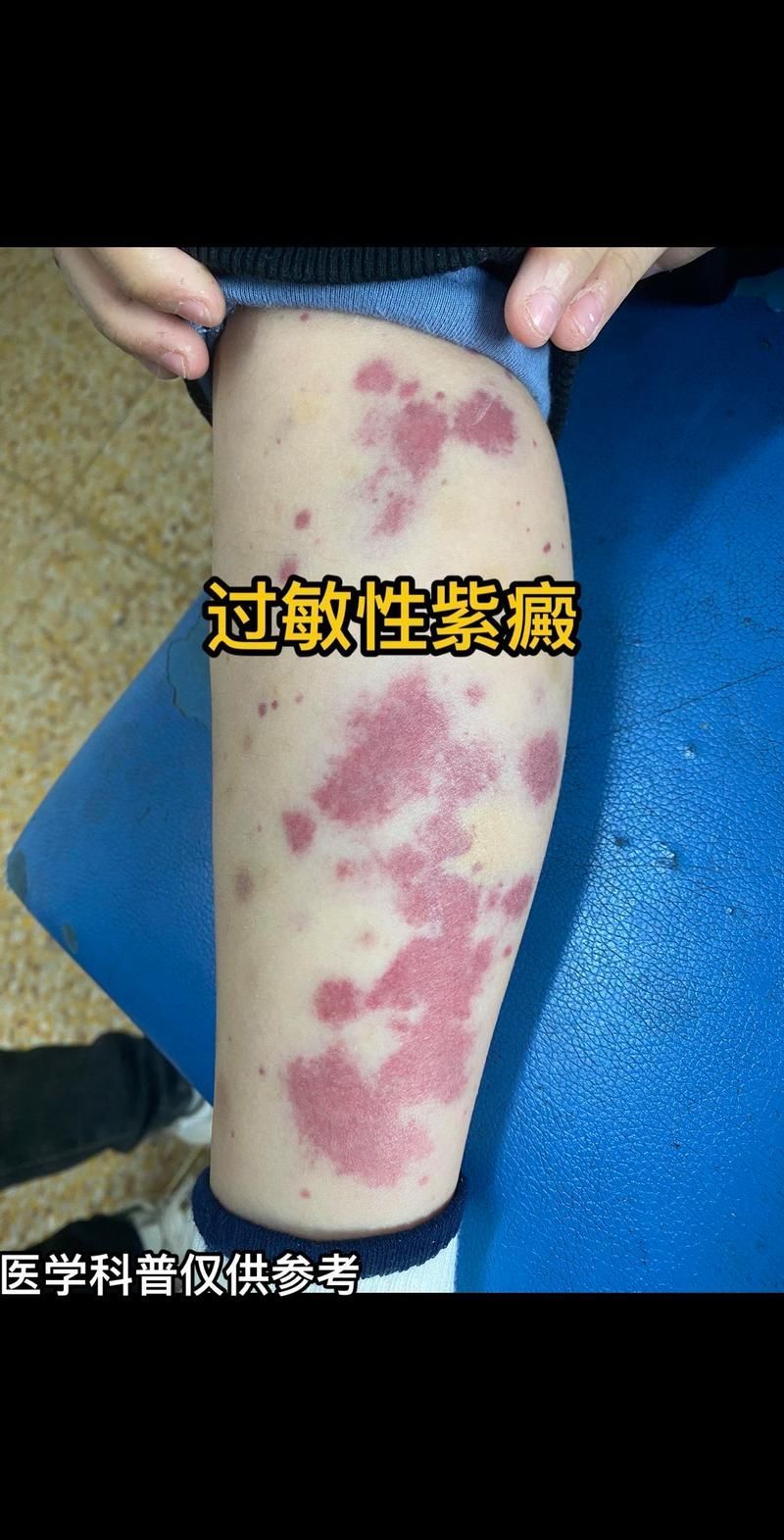 能否提供更多早期癥狀的圖片，早期癥狀的識別與分析