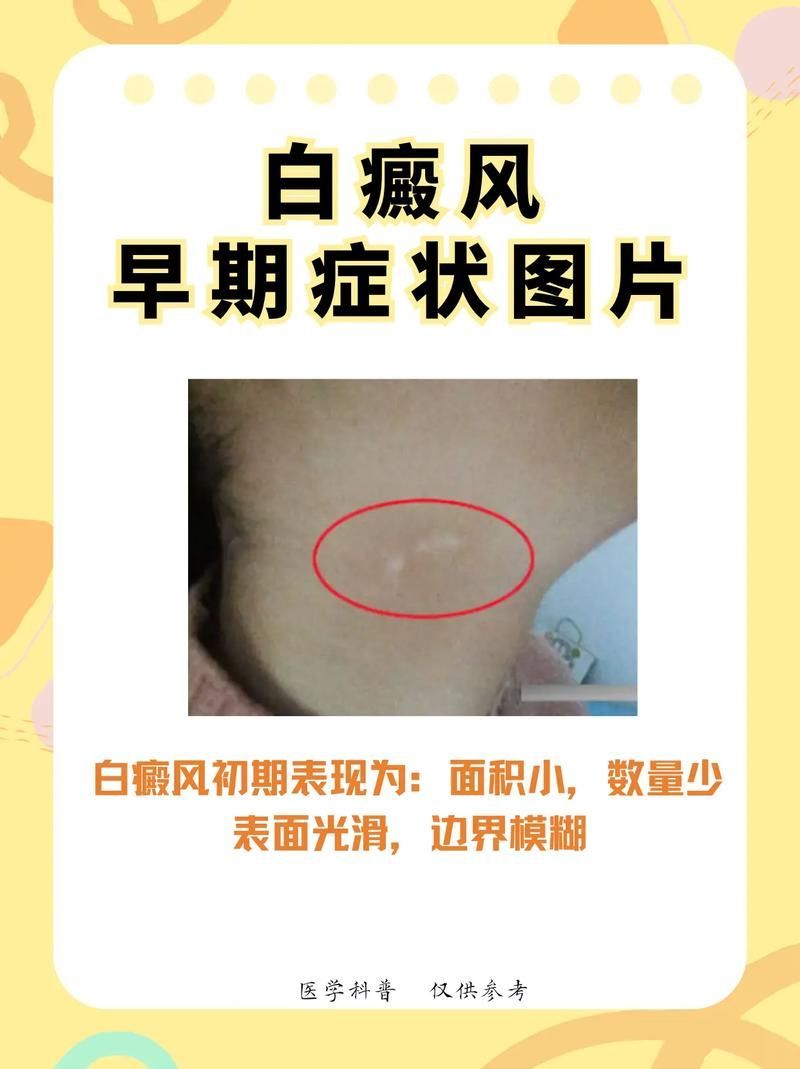 能否提供更多早期癥狀的圖片，早期癥狀的識別與分析