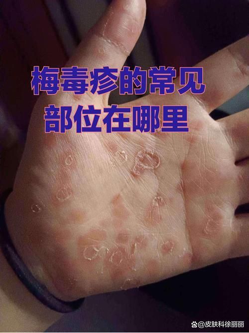 能否提供更多早期癥狀的圖片，早期癥狀的識別與分析