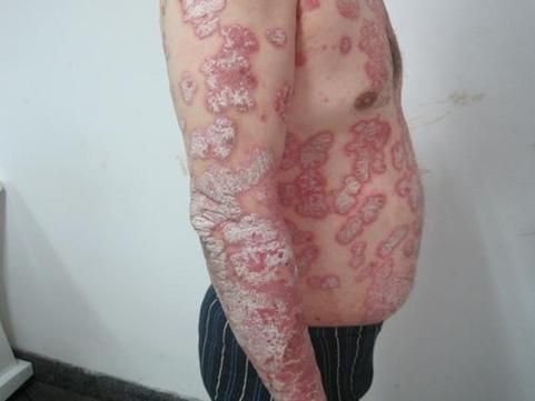 能否提供更多早期癥狀的圖片，早期癥狀的識別與分析