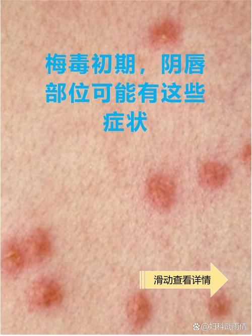 能否提供更多早期癥狀的圖片，早期癥狀的識別與分析