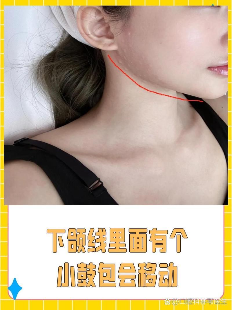 病理性下顎鼓起如何治療，病理性下顎鼓起如何治療病理性下顎鼓起如何治療