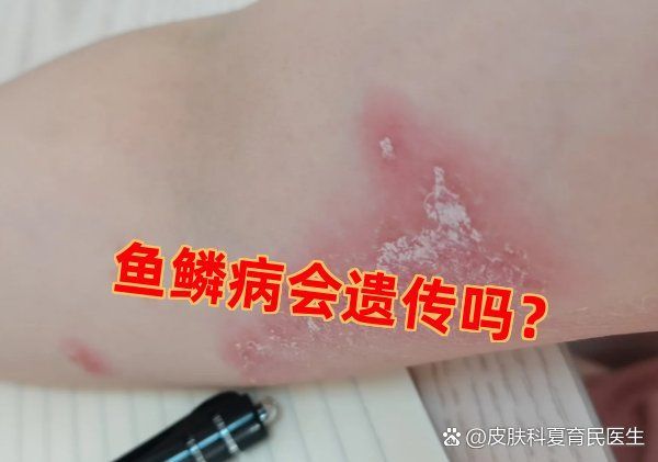 魚鱗病患者可以結婚生子嗎，魚鱗病患者可以結婚生子嗎魚鱗病患者可以結婚生子嗎