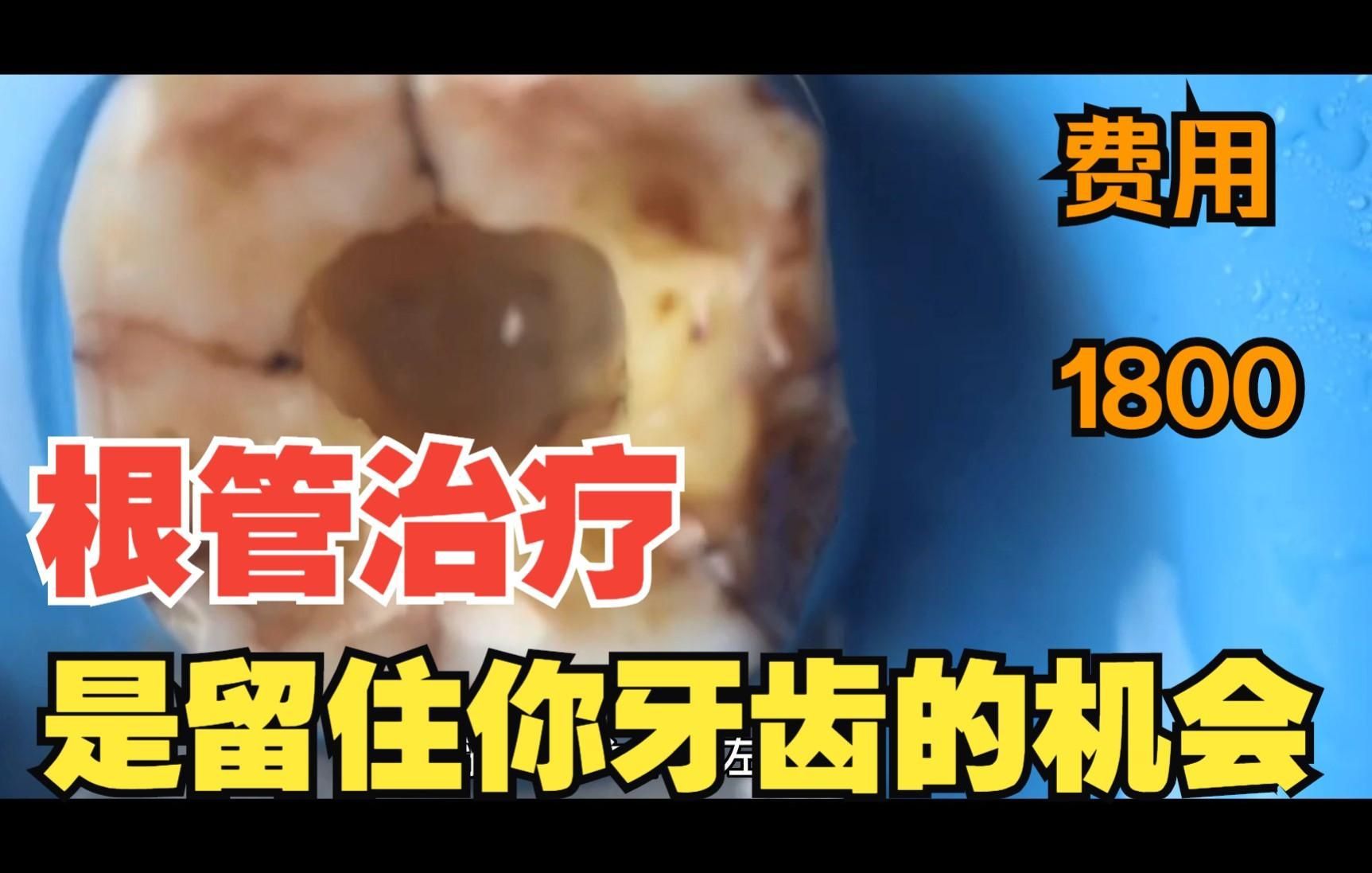 根管治療費(fèi)用大概是多少，古龍小說(shuō)中哪個(gè)人物最受歡迎根管治療費(fèi)用大概是多少