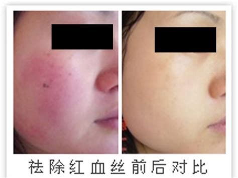 紅血絲簡單去除方法，去紅血絲前后對比圖
