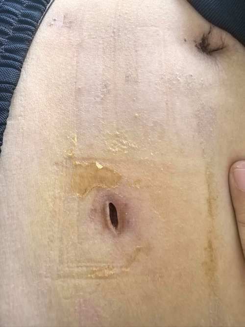 能否提供龍魚傷口愈合的詳細圖片，龍魚傷口愈合的詳細圖片描述：龍魚傷口愈合過程的詳細圖片描述