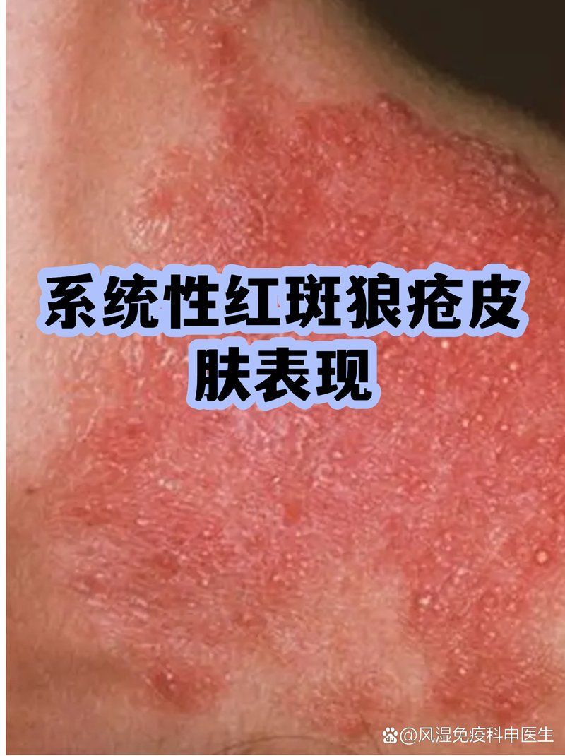 紅斑病和赤皮病如何治療，紅斑病與赤皮病的區別