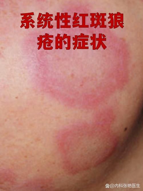 紅斑病和赤皮病如何治療，紅斑病與赤皮病的區別
