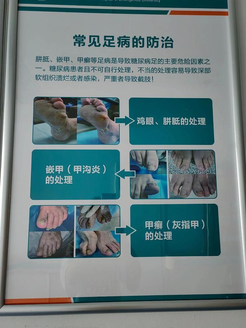 如何預防爛身病，權威醫學指南中關于“爛身病”的預防措施（如cdc、mayoclinic）