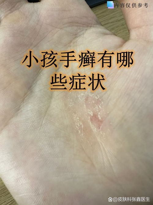 能否提供更多真菌和細(xì)菌感染的典型圖片，如何區(qū)分真菌和細(xì)菌感染