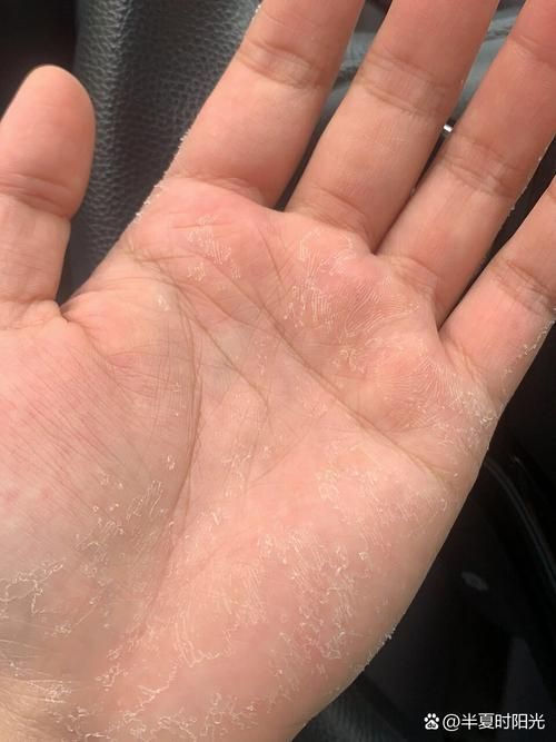 能否提供更多真菌和細(xì)菌感染的典型圖片，如何區(qū)分真菌和細(xì)菌感染