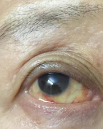 龍魚紅眼病治療方法，redeyediseaseinarowana龍魚紅眼病治療方法詳解